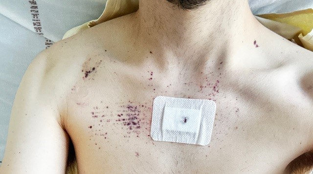 Figure 1. Purpura on the torso after bone marrow aspirate attempts.