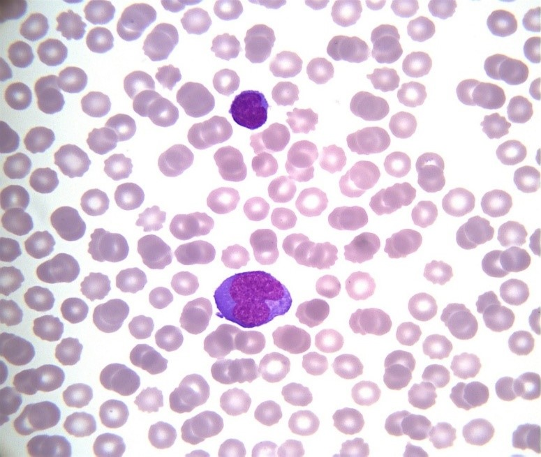 Figure 2. Activated hyperbasophilic lymphocytes between a normal-sized one on peripheral blood smear (Wright–Giemsa stain, oil immersion, magnification ×1000)