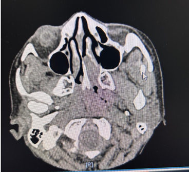 Figure 1.  CT scan of paranasal sinuses depicting a well-defined mass in the superior left nasal cavity abutting but not breaching the cribriform plate, with no intracranial extension.