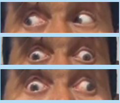 Figure 1. Clinical photographs demonstrating features of internuclear ophthalmoplegia (INO). Sequential gaze positions show impaired adduction of the right eye on left gaze with associated abducting nystagmus of the contralateral eye, while primary gaze alignment appears relatively preserved—findings consistent with right-sided INO due to medial longitudinal fasciculus involvement.