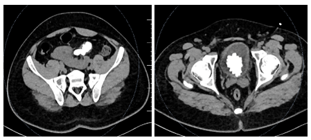 Figure 2: CT KUB suggestive pelvic kidney with large renal calculi and bladder calculus.