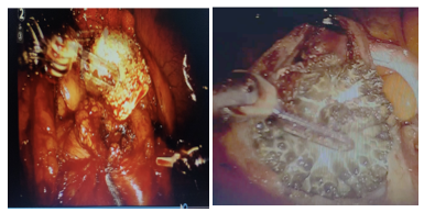 Figure 3:- Intraoperative images showing robotic pyelolithotomy with cystolithotomy