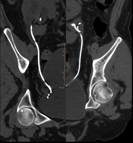 Figure 4:- Post operative CT KUB suggestive of bilateral DJ stent in-situ with no  residual stone fragments