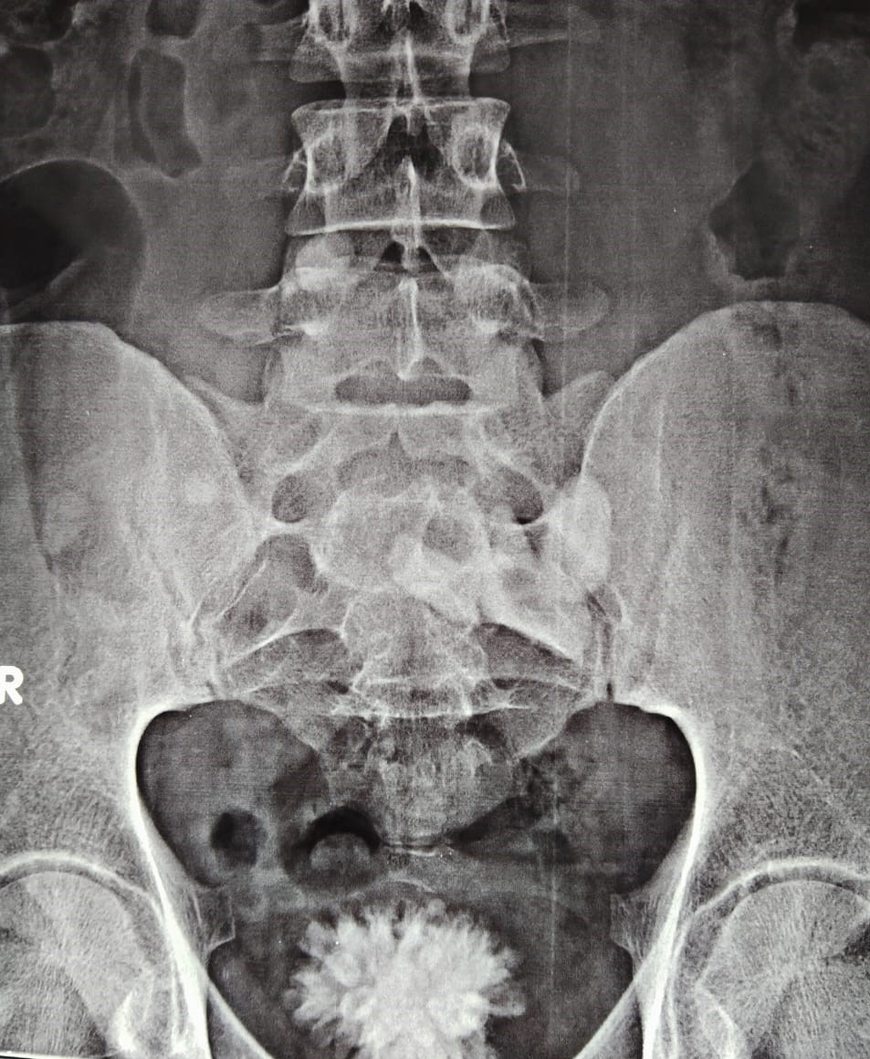 Figure 1:- Large Vesical calculus seen in X-Ray KUB.