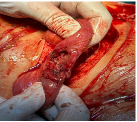 Figure 1: Intraoperative finding showing fundal uterine rupture