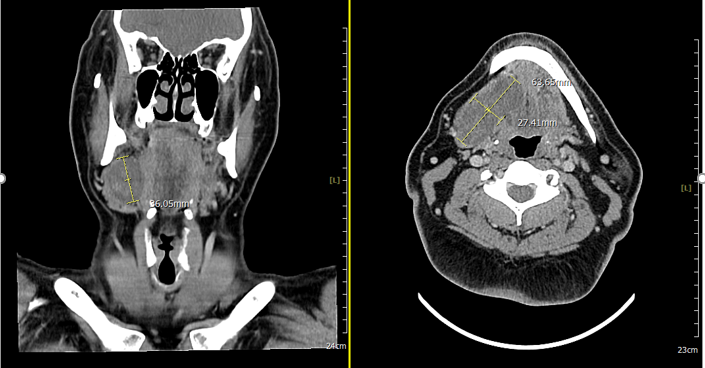 Figure 1:- Well-circumscribed cystic/low-attenuation mass in the right submandibular space with superior extension into the ipsilateral sublingual space, causing mass efect on the submandibular gland without definite invasive features.