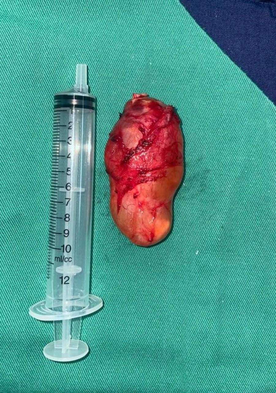 Intraoperative Specimen showing a cystic mass.