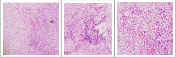Figures 3 (Left–Middle–Right, H&E): Left (4×): Schwannoma showing alternating Antoni A(hypercellular) and Antoni B (hypocellular/myxoid) areas. Middle (10×): Verocay bodies with nuclear palisading in parallel rows separated by acellular eosinophilic (basement membrane–like) material. Right (4×): Focal clusters of thick-walled vessels with prominent perivascular hyalinization.