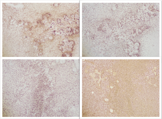 Figures 4: (Composite immunohistochemistry, 4×; clockwise from upper left ): CD38 shows no immunoreactivity in tumor cells (negative), CD163 highlights no lesional histiocytic population (negative), S100 shows diffuse strong positivity and SOX10 demonstrated strong nuclear positivity in tumor cells confirming Schwann cell differentiation in keeping with schwannoma.