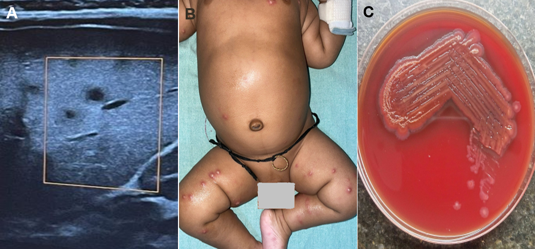 Figure 1.A) High-resolution ultrasound of 40-day old male with persisting fever spikes showing multiple hepatic micro-abscesses B) Multiple pustular lesions over the trunk and extremities at 45 days of life C) Blood agar showing pink colored colonies of Roseomonas species.
