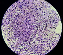 Fig 2: Histopathology examination showed sheets of mature and atypical plasmacytoid cells suspicious of plasma cell neoplasm.