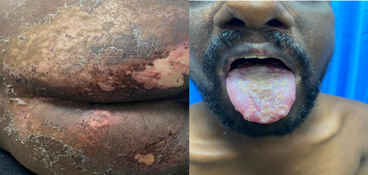 Figure 1: Mucocutaneous involvement in TAMA and Good’s syndrome – (Left) hyperpigmented exfoliative and erosive lesions over the gluteal region, (Right) whitish plaques over the tongue with erythematous base suggestive of oral mucosal involvement.