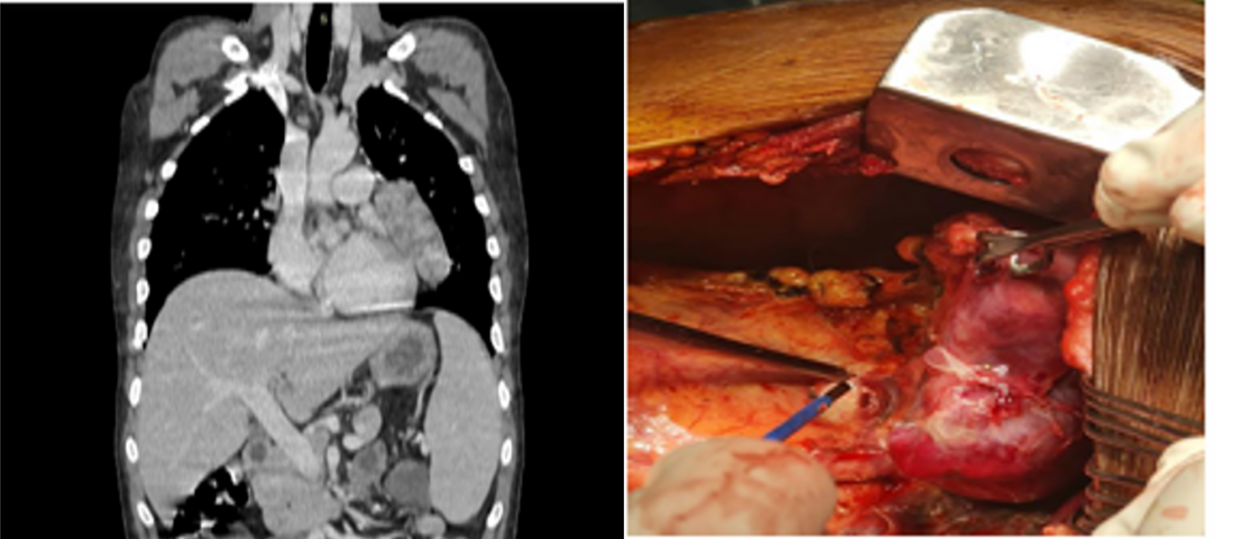 Figure 2: Imaging and intraoperative findings of anterior mediastinal mass – (Left) contrast-enhanced CT showing a well-defined lobulated anterior mediastinal mass, (Right) intraoperative view demonstrating surgical excision of the thymoma.