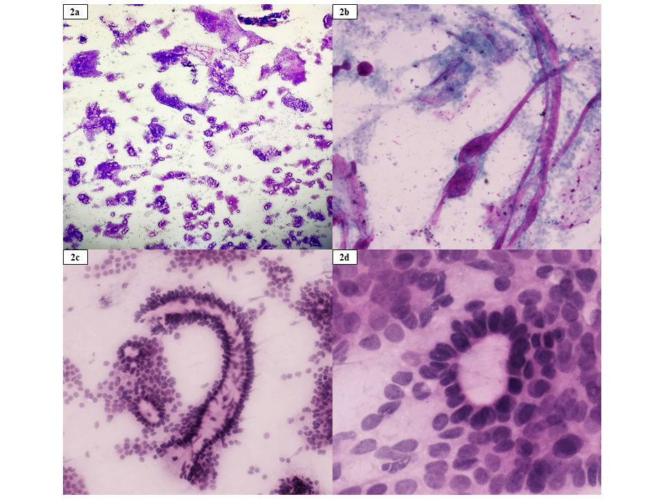 Figure 2:- Fine needle aspiration cytology findings (Clockwise from the left upper corner) low-power view (2×, H&E) showing hypercellular smears with cohesive clusters of tumor cells; thick basement membrane–like material with magenta-colored hyaline globules surrounded by tumor cells (20×, Giemsa); tumor cells with hyperchromatic nuclei and scant cytoplasm arranged around hyaline material with peripheral palisading (20×, H&E); high-power view (40×, H&E) highlighting basaloid tumor cells with marked nuclear hyperchromasia and minimal cytoplasm adherent to hyaline globules.
