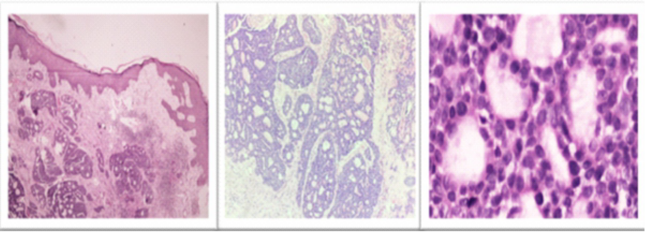 Figure 3: Histopathological features of primary cutaneous adenoid cystic carcinoma (Left to right): low-power view (4X, H&E) demonstrating an unencapsulated, infiltrative dermal tumor with no connection to the overlying epidermis; cribriform growth pattern with characteristic “punched-out” spaces containing hyalinized material (20×, H&E); high-power view (40X, H&E) showing basaloid tumor cells with scant cytoplasm and round hyperchromatic nuclei.