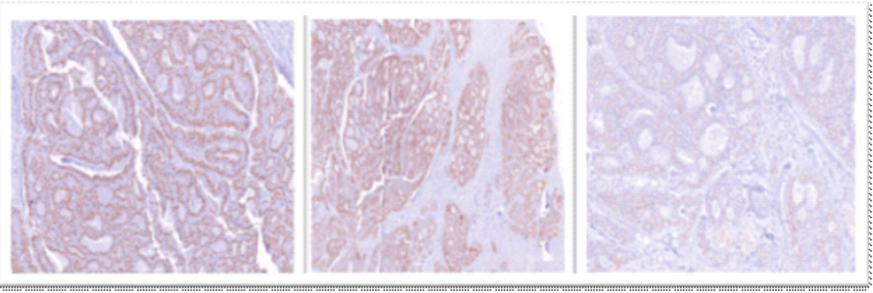 Figure 4:- Immunohistochemical features of primary cutaneous adenoid cystic carcinoma (Left to right): p63 immunostaining (20×) showing strong nuclear positivity in basaloid tumor cells, confirming myoepithelial differentiation; pan-cytokeratin immunostaining (10×) demonstrating diffuse cytoplasmic positivity supporting epithelial origin; CD117 immunostaining (20×) revealing focal faint cytoplasmic positivity in tumor cells, aiding distinction from histologic mimics.