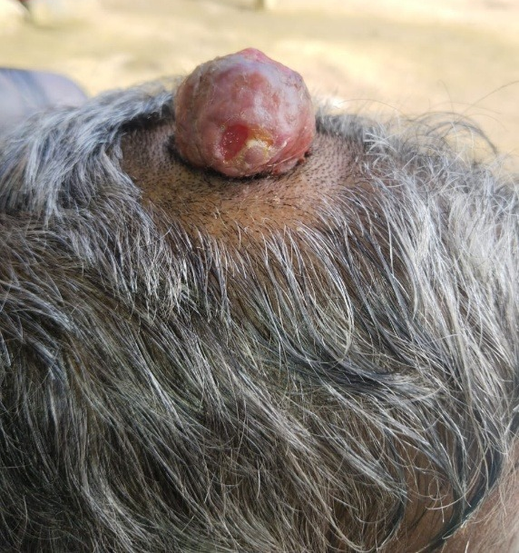 Fig. 1. Clinical presentation of the scalp lesion. A 4 × 4 cm globular, ulcerated, firm, and non-mobile swelling on the vertex of the scalp.
