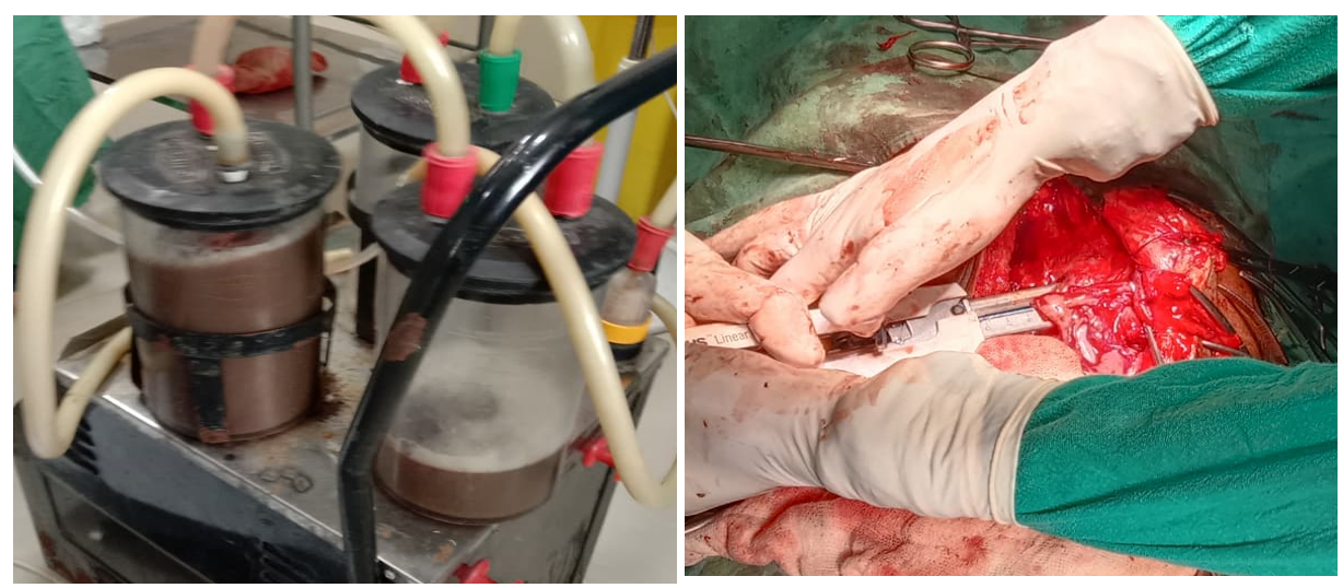 Figure 3: Intraoperative images from surgical management of the prehepatic pancreatic pseudocyst. Left: Suction containers showing approximately 2.5 Liters of thick, brownish cystic fluid drained from the pseudocyst cavity. Right: Intraoperative view demonstrating cystogastrostomy and stapling device.