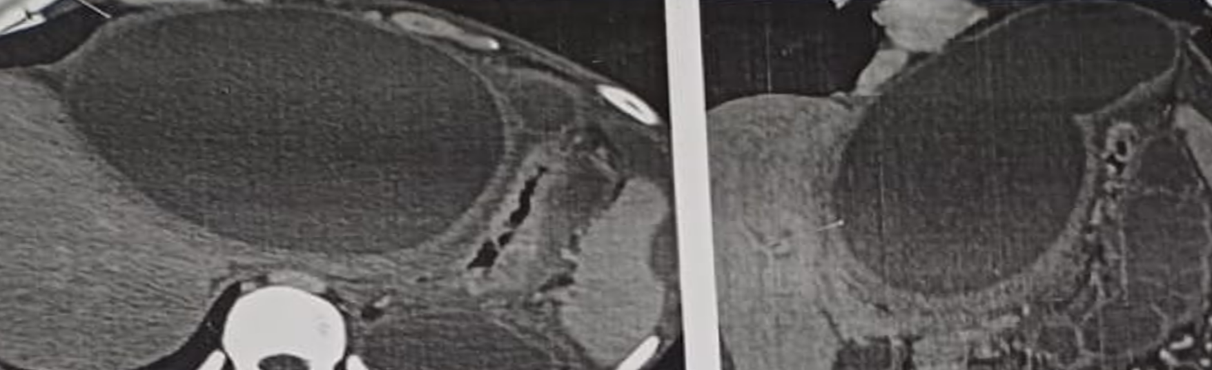 Figure 2: Contrast-enhanced computed tomography (CECT) axial and coronal images showing a large, well-defined, thick-walled cystic lesion located in the prehepatic region anterior to the liver, causing significant mass effect on the stomach. The lesion is consistent with a pancreatic pseudocyst in an atypical prehepatic location, with communication to the pancreatic duct suggestive of chronic pancreatitis