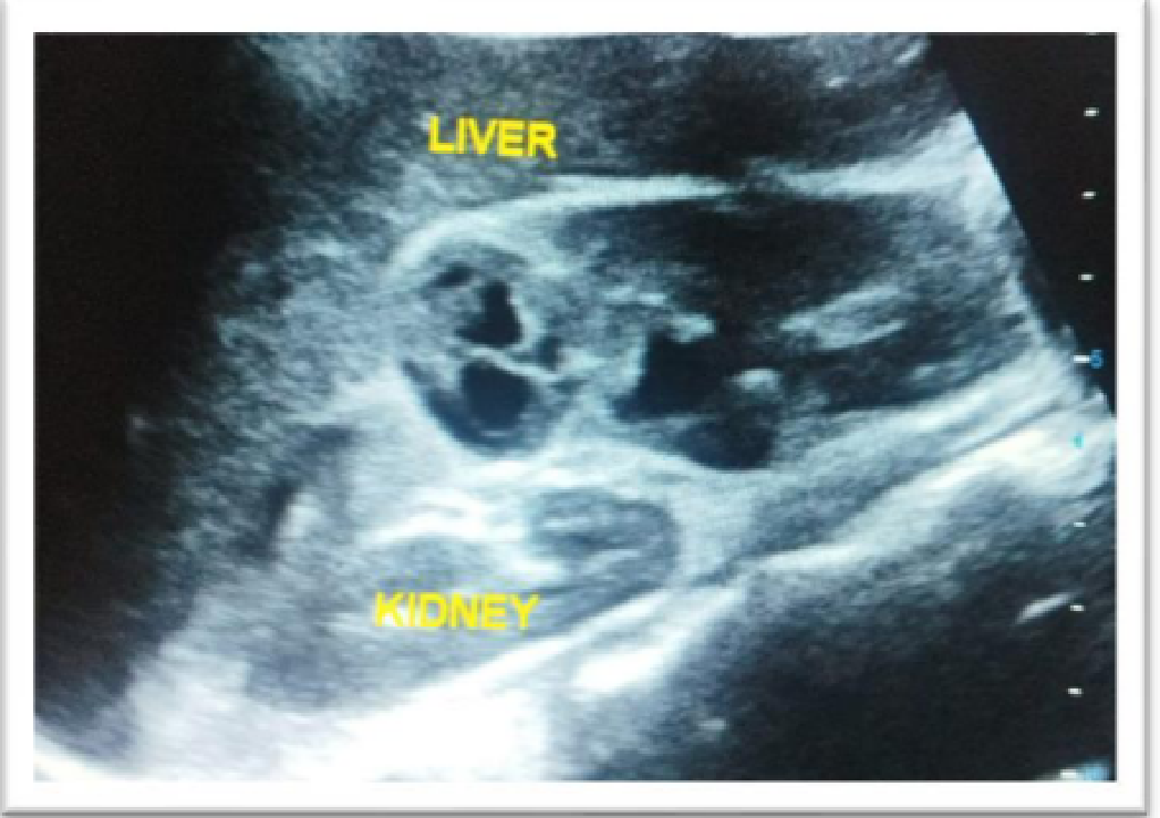 Figure  1:-well-defined  cystic  mass  in Midpole of right   kidneywith   septations   s/o   renal hydatid cyst