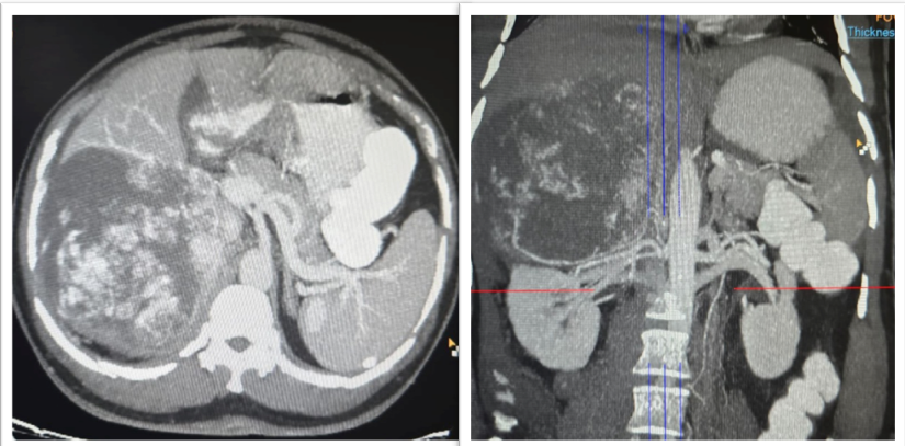 Contrast-enhanced  computed  tomography  (CECT)  of  the  abdomen  showing  a  large  heterogeneously  enhancing retroperitoneal mass. (Left) Axial CT image demonstrating a well-defined heterogeneous mass in the right upper retroperitoneum, inseparable from the upper pole of the right kidney with apparent involvement of adjacent hepatic parenchyma. (Right) Coronal CT  reconstruction  showing  the  craniocaudal  extent  of  the  lesion  with  close  proximity  to  the  right  kidney  and  liver,  raising radiologic suspicion of a malignant renal neoplasm with hepatic extension.