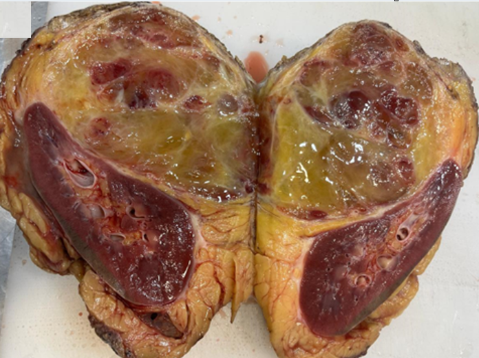 Gross  photograph  of  the  resected  specimen showing  a  large,  well-circumscribed  retroperitoneal  mass excised along with the right kidney. On cut section, the tumor appears lobulated and pale yellowish-brown with a soft to focally  spongiform  consistency,  showing  areas  of  edema, myxoid change, and focal hemorrhage.
