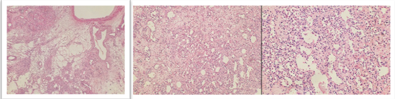 Histopathological  examination  showing Encapsulated,  lobulated  vascular  tumor  composed  of anastomosing  capillary-sized  channels  lined  by  bland hobnail  endothelial  cells,  with  minimal  atypia  and  rare mitoses. Focal fibrin thrombi, RBC extravasation, and focal extramedullary  haematopoiesis  are  present  within  an edematous–hyalinized/myxoid  stroma  with  smooth  muscle proliferation.