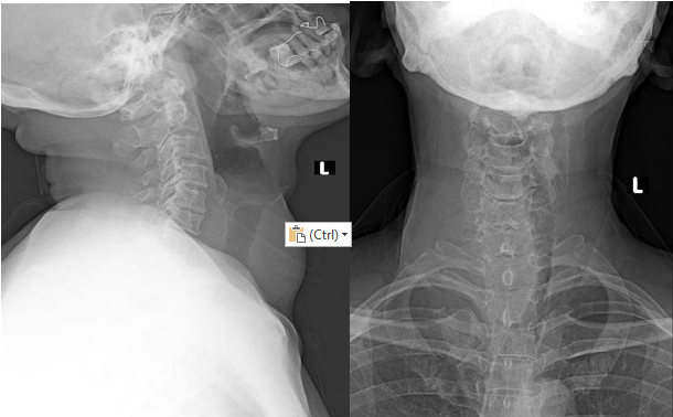 Lateral and Anteroposterior cervical radiographs showing a right-sided neck softtissue mass with leftward tracheal deviation and airway narrowing at C7–T2.