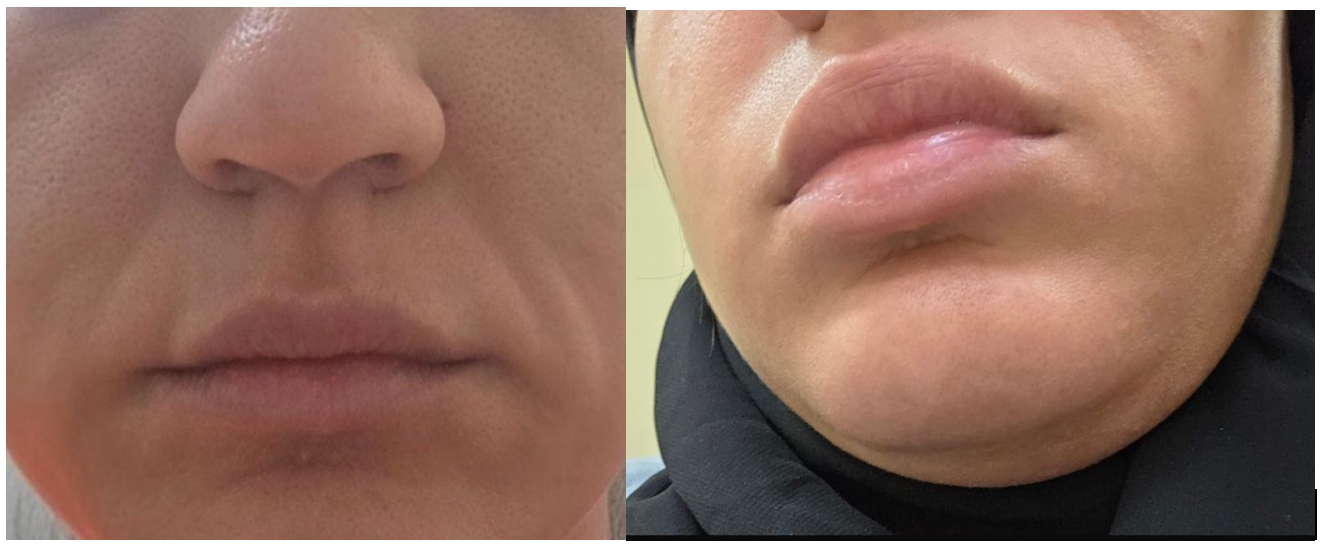 Clinical photographs showing episodic facial swelling during an attack. Patient's baseline facial appearance (Left); Acute swelling involving the lips, perioral region, and lower face consistent with non-pitting angioedema during an episode (Right).