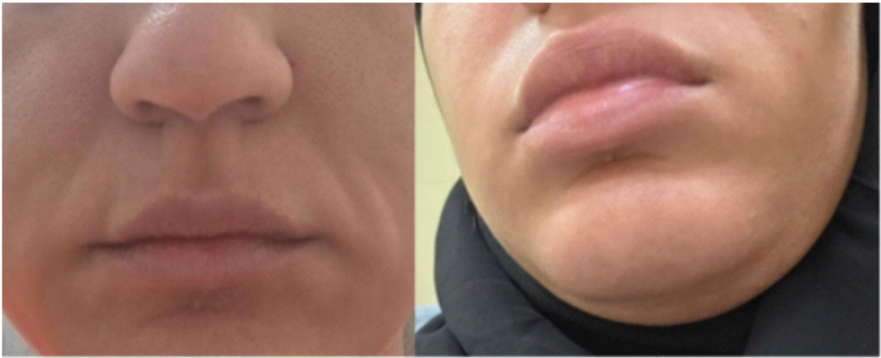 Figure  1.  Clinical  photographs  showing  episodic  facial swelling  during  an  attack.  Patient's  baseline  facial appearance (Left); Acute swelling involving the lips, perioral region,  and  lower  face  consistent  with  non-pitting angioedema during an episode (Right)