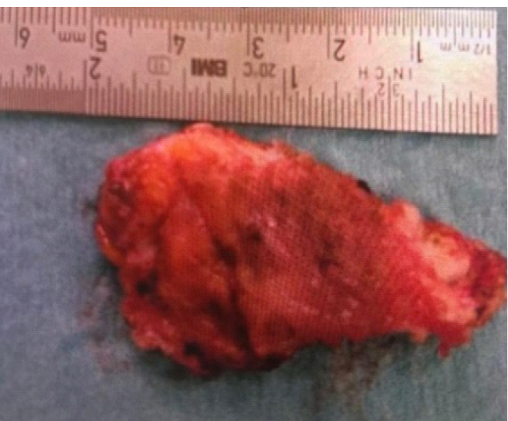 Figure 1: Gross specimen of the excised abdominal wall mass measuring 5 × 3 × 2 cm.